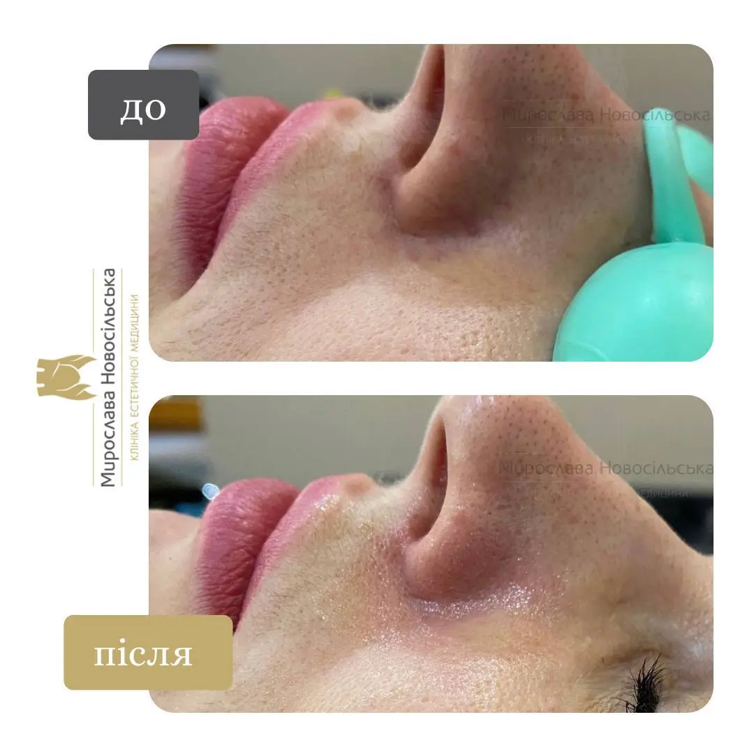 Лазерне видалення судин, фото 7