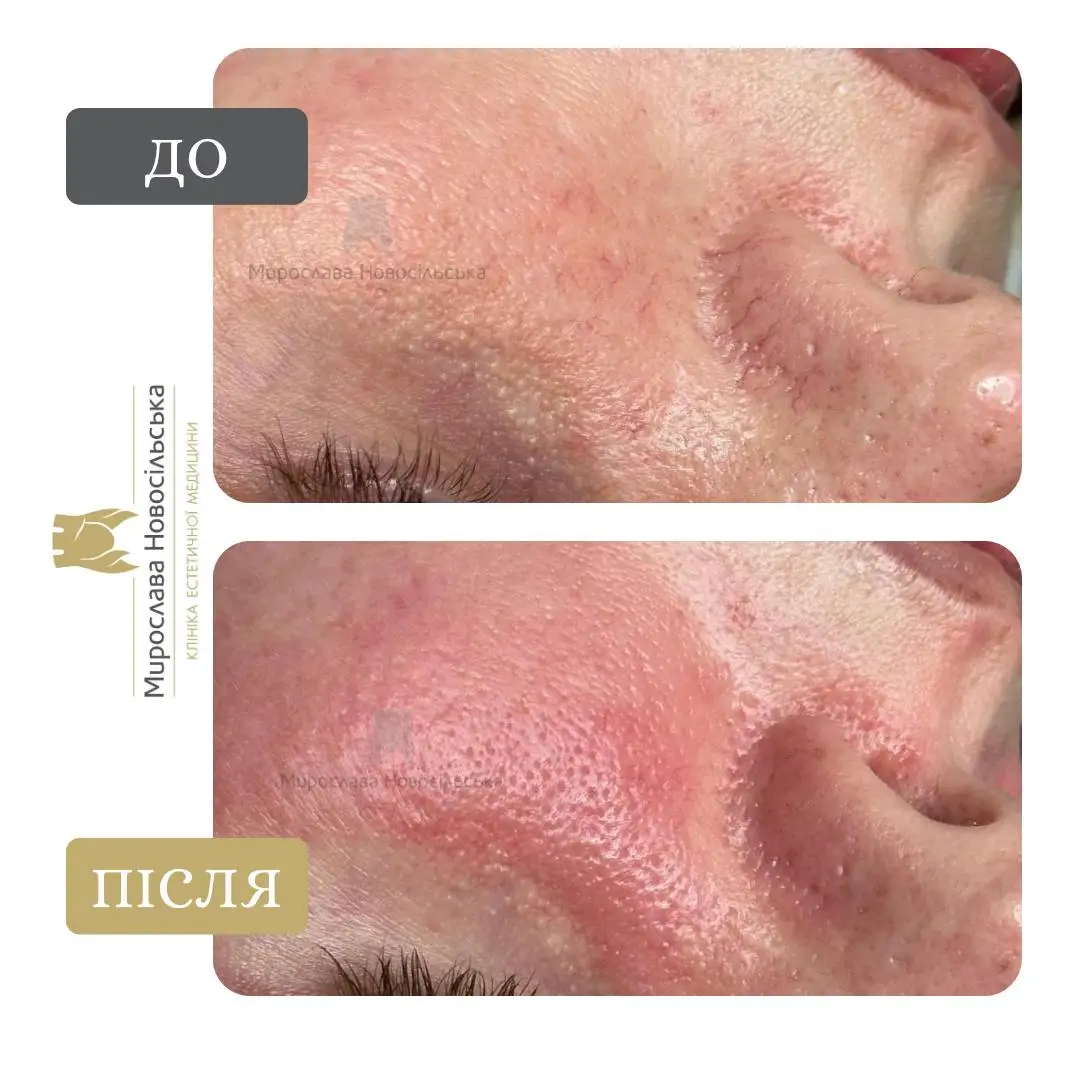 Лазерне видалення судин, фото 8
