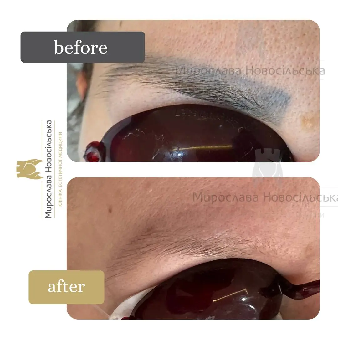 Laser removal of permanent makeup, photo 5
