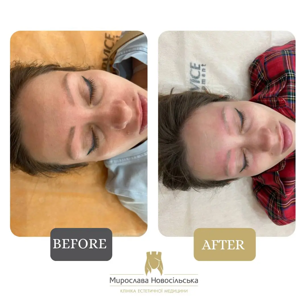 Laser removal of permanent makeup, photo 2