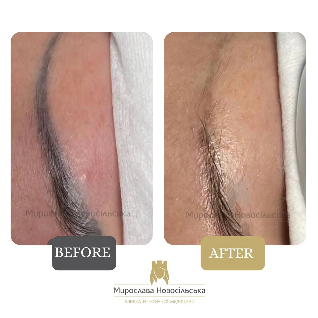 Laser removal of permanent makeup