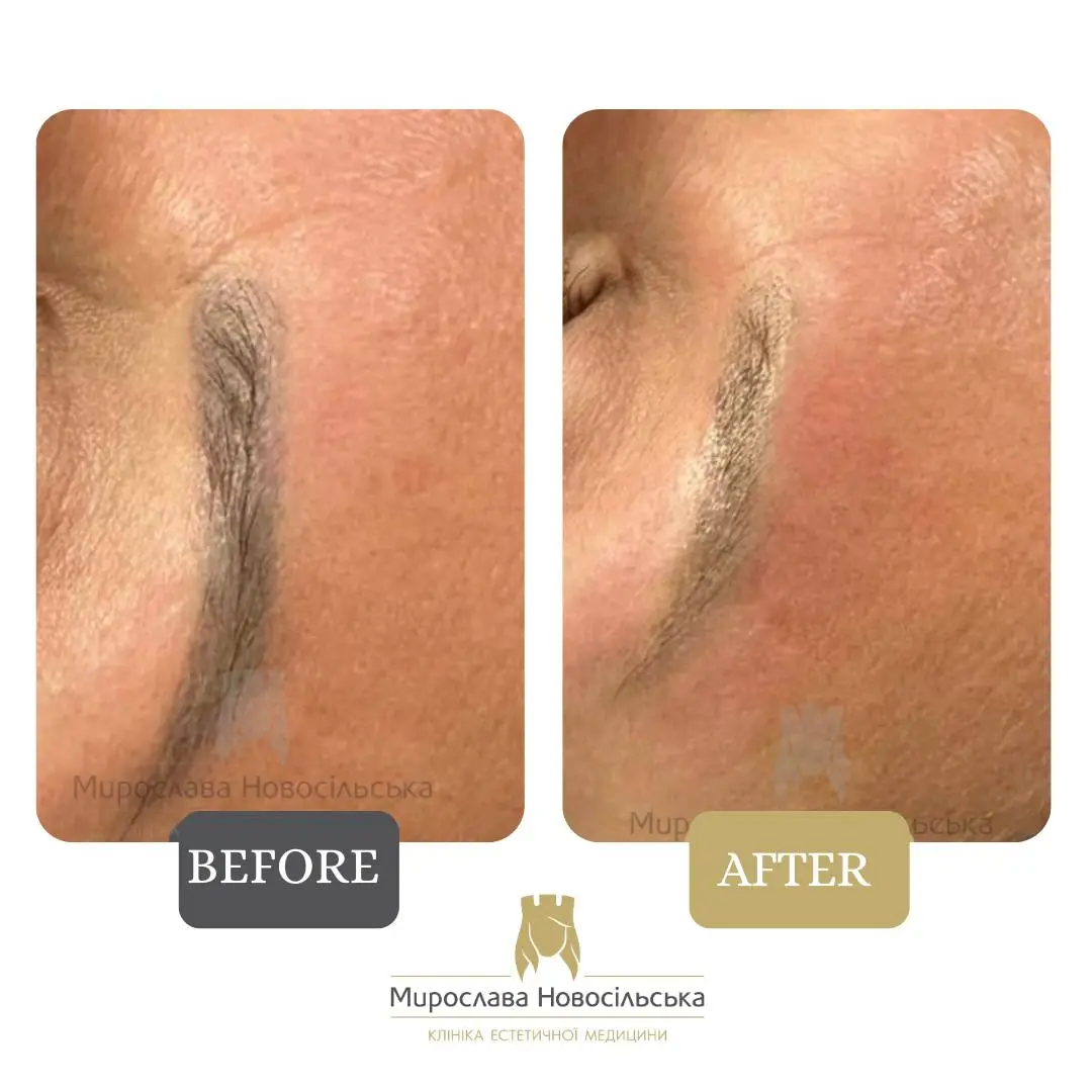 Laser removal of permanent makeup, photo 4