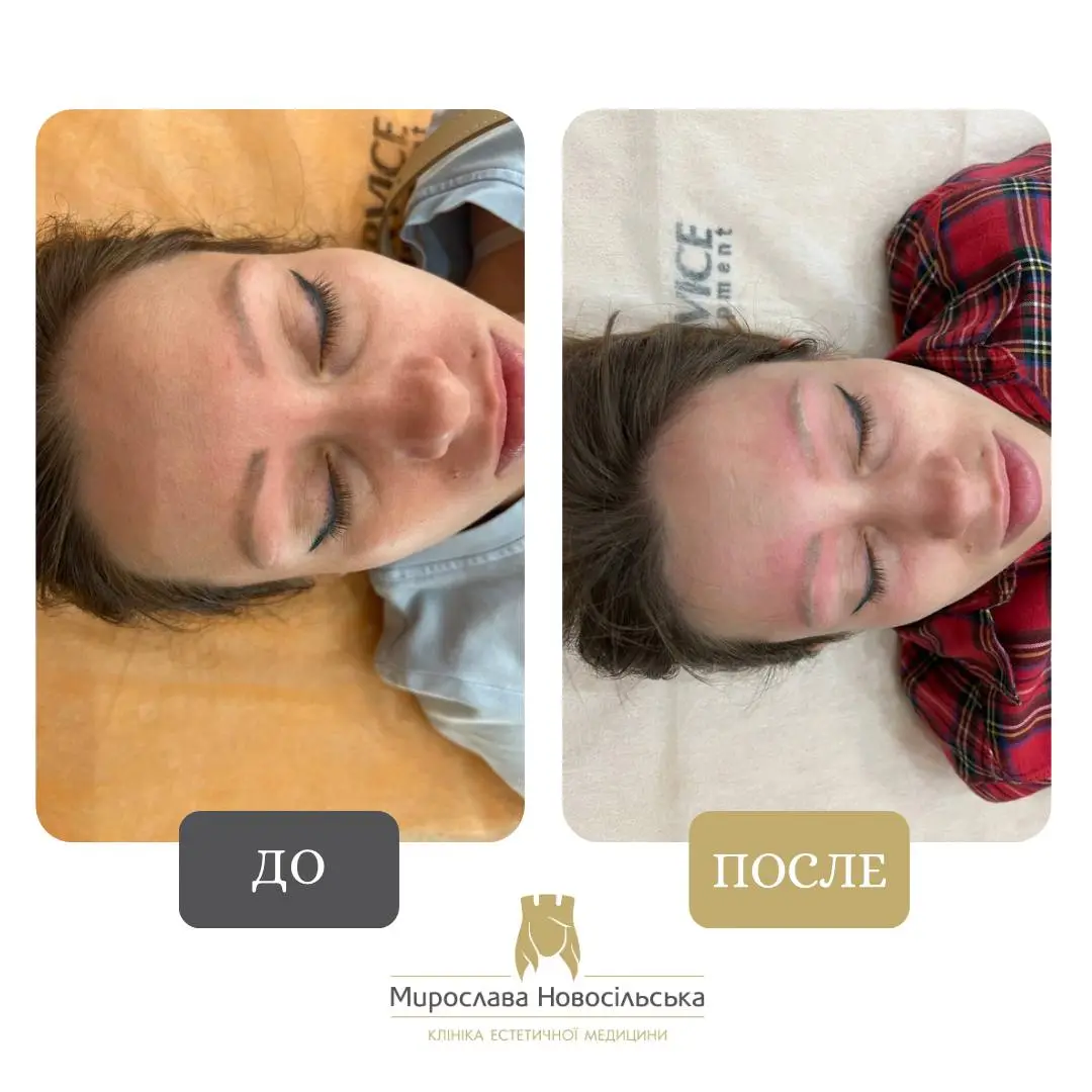 Лазерное удаление татуажа, фото 2