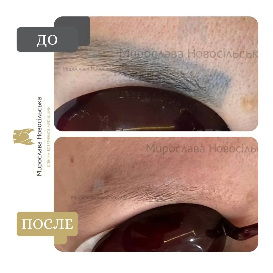 Лазерное удаление татуажа, фото 5