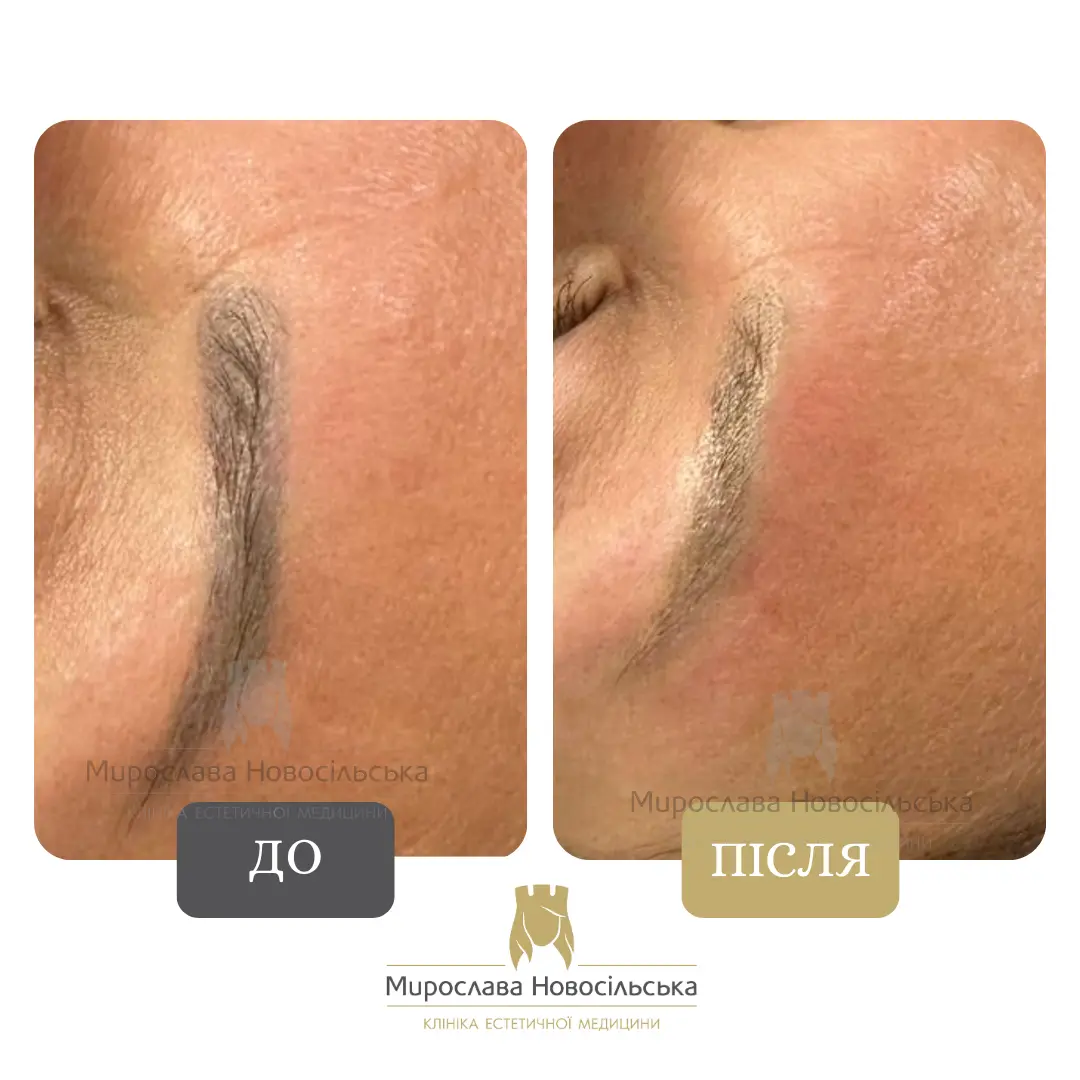 Лазерне видалення татуажу брів, фото 4