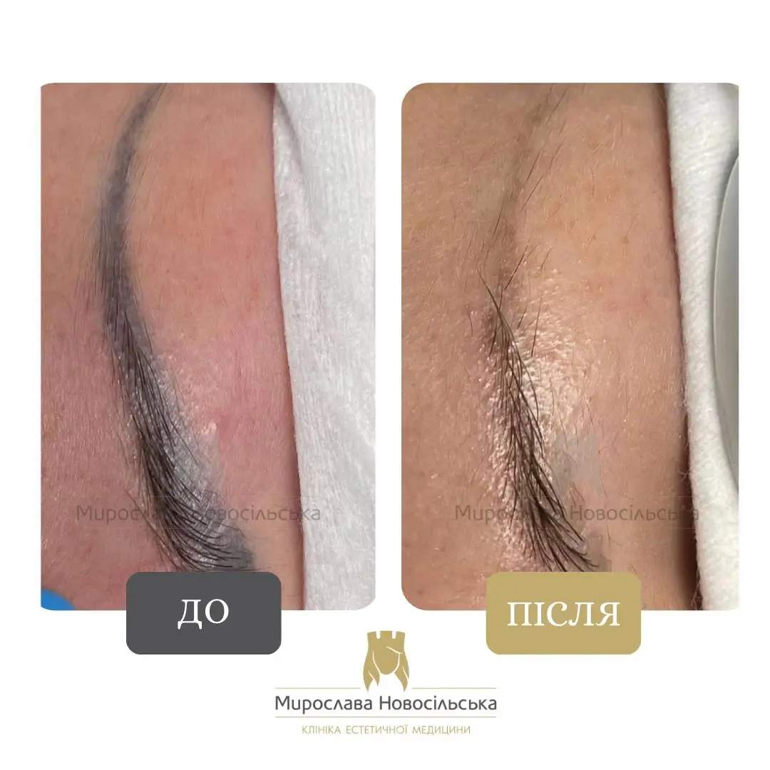 Лазерне видалення татуажу брів, фото 3