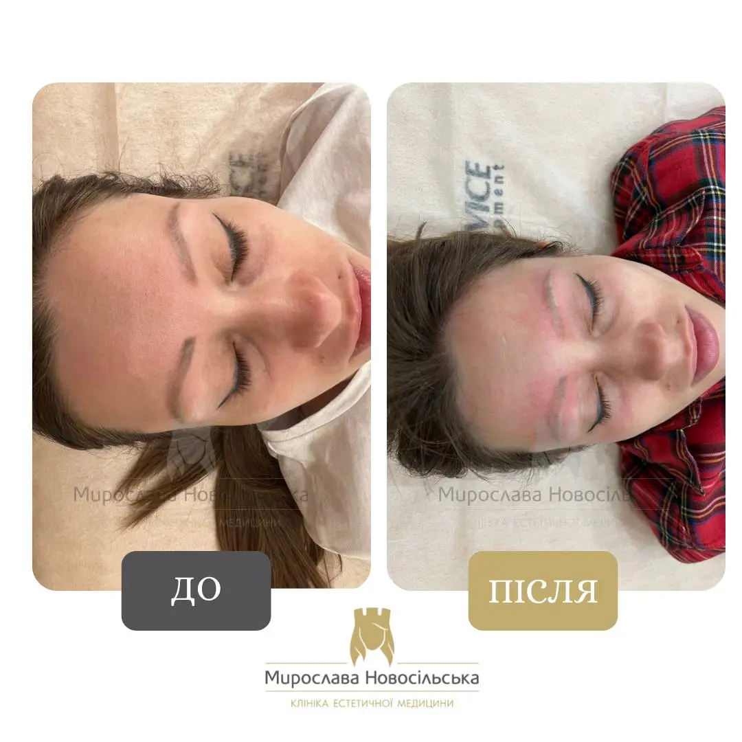 Лазерне видалення татуажу брів, фото 2