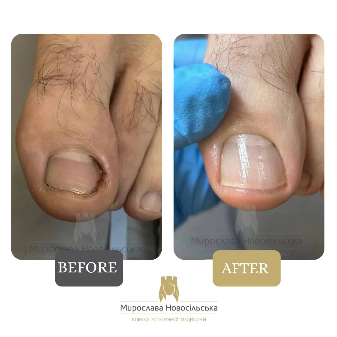 Removal of an ingrown nail, photo 5