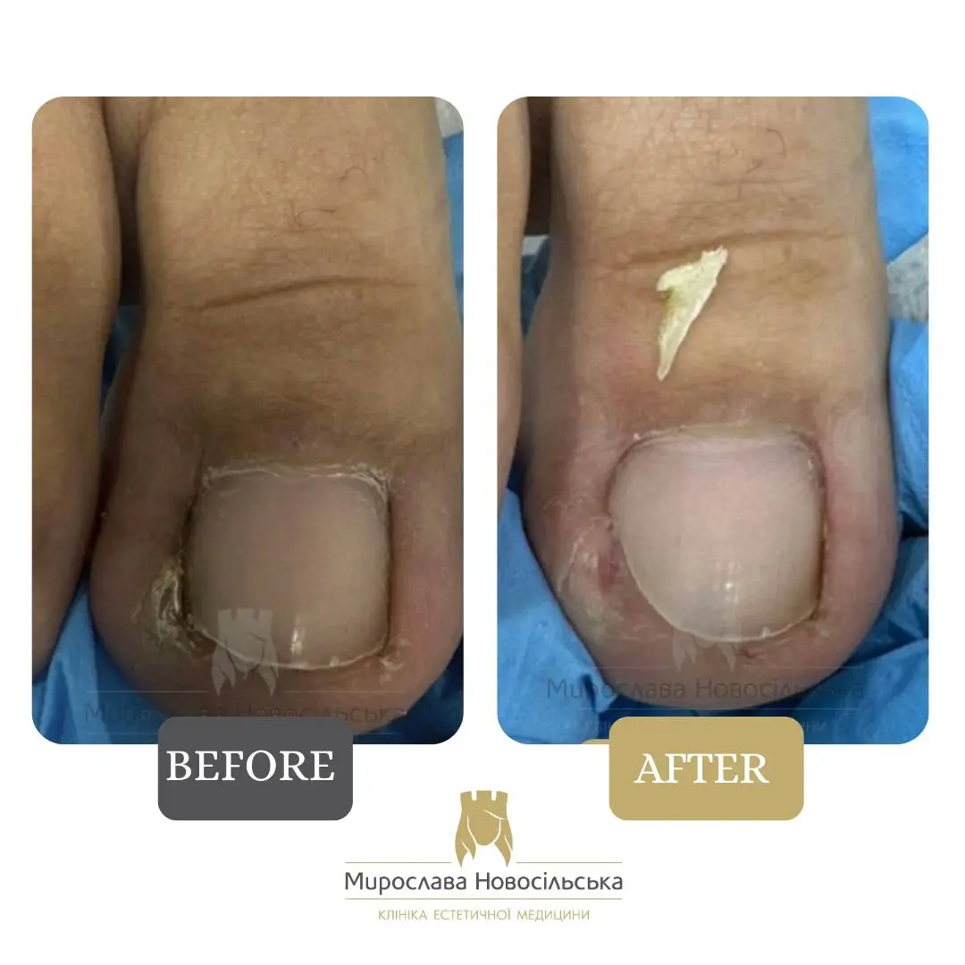 Removal of an ingrown nail, photo 8