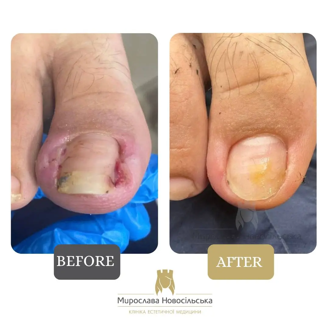 Removal of an ingrown nail, photo 6