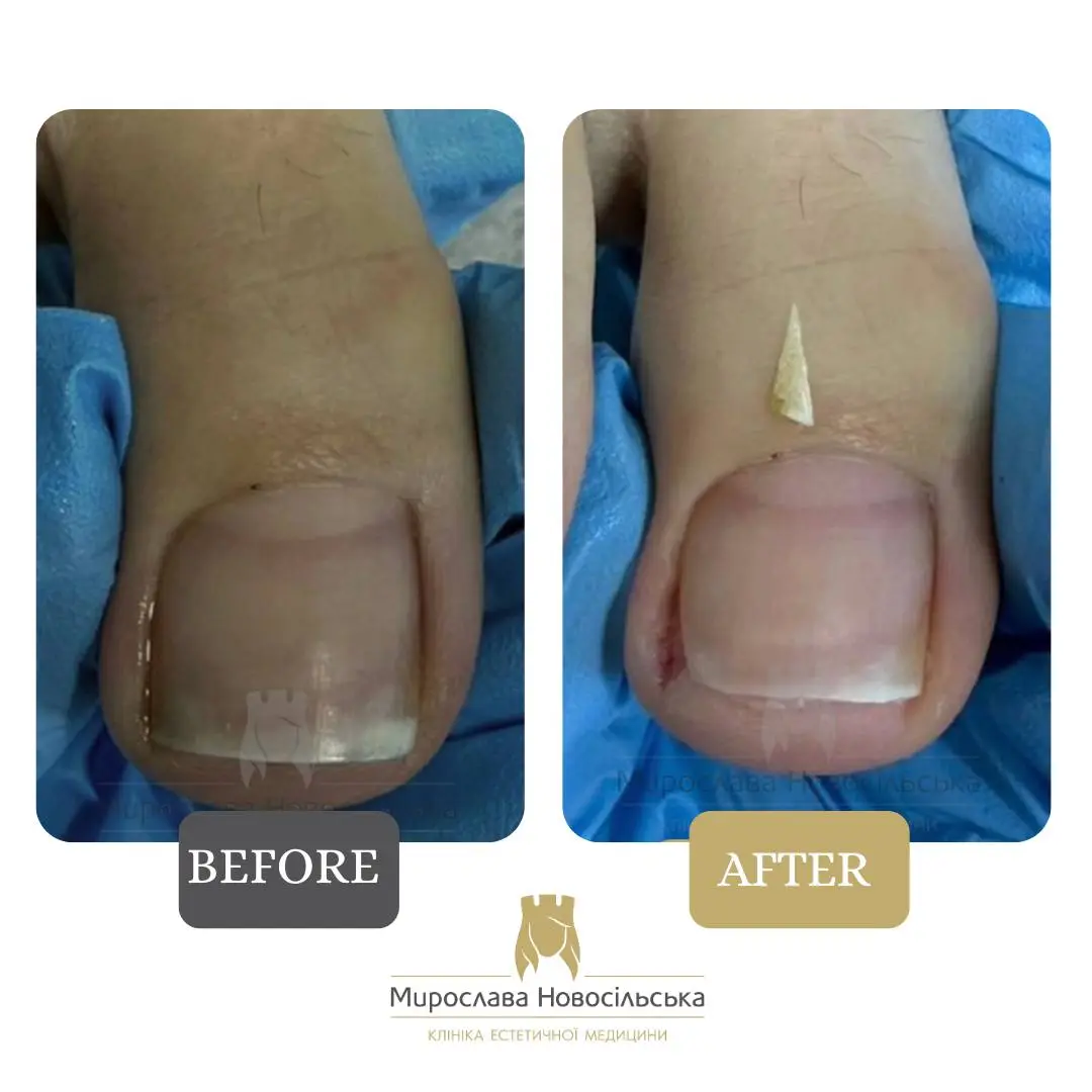 Removal of an ingrown nail