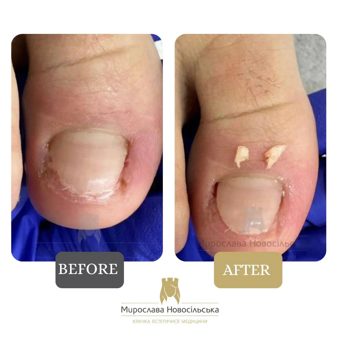 Removal of an ingrown nail