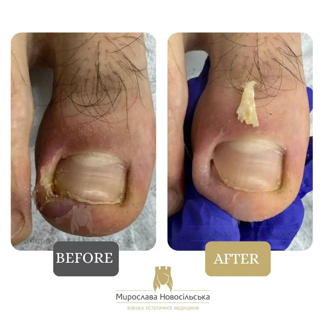 Removal of an ingrown nail, photo 7