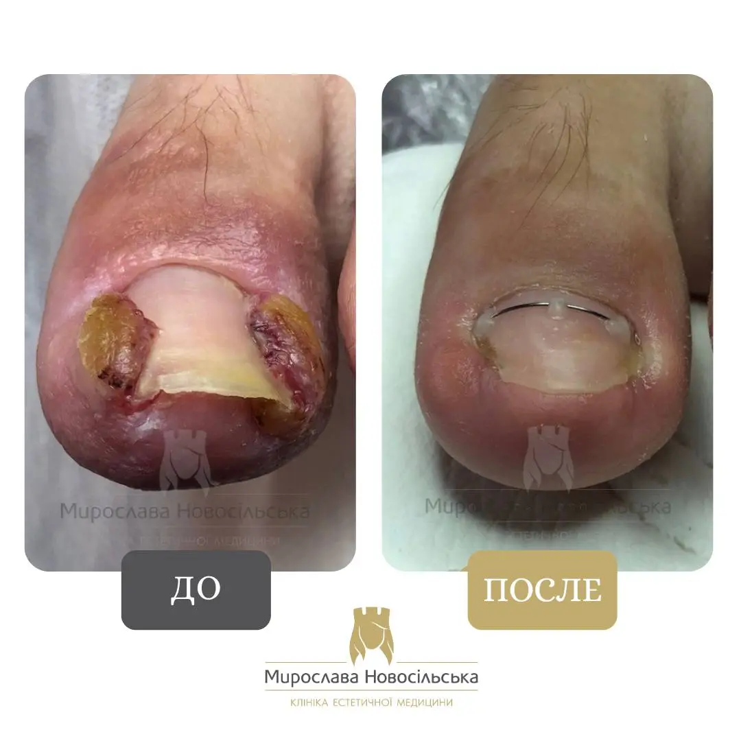 Удаление вросшего ногтя, фото 2