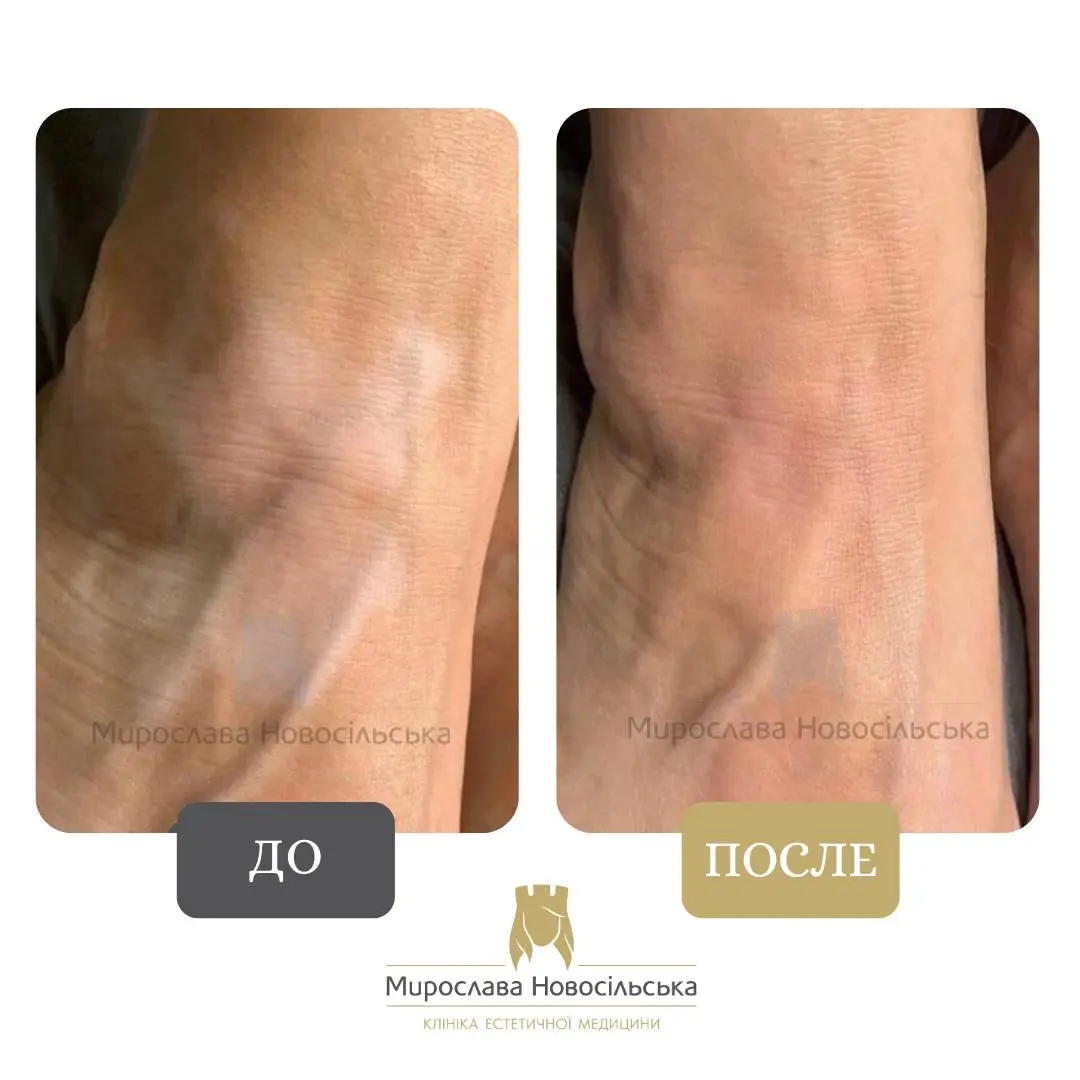 Лазерное лечение витилиго, фото 2