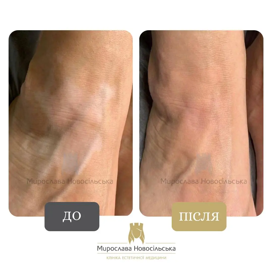 Лазерне лікування вітіліго, фото 2