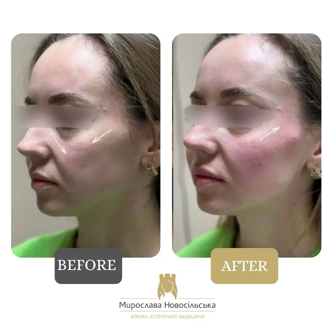 Facial fillers, photo 3