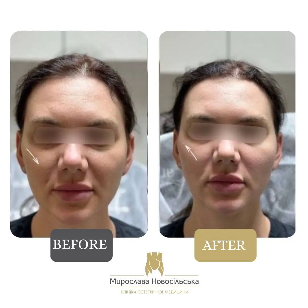 Facial fillers, photo 4