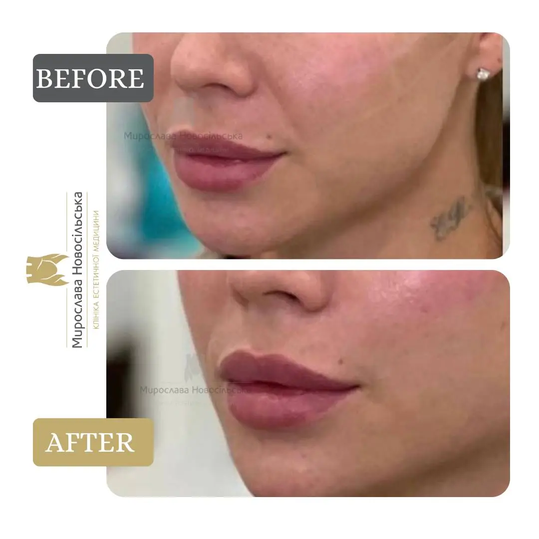 Radiesse injections, photo 4