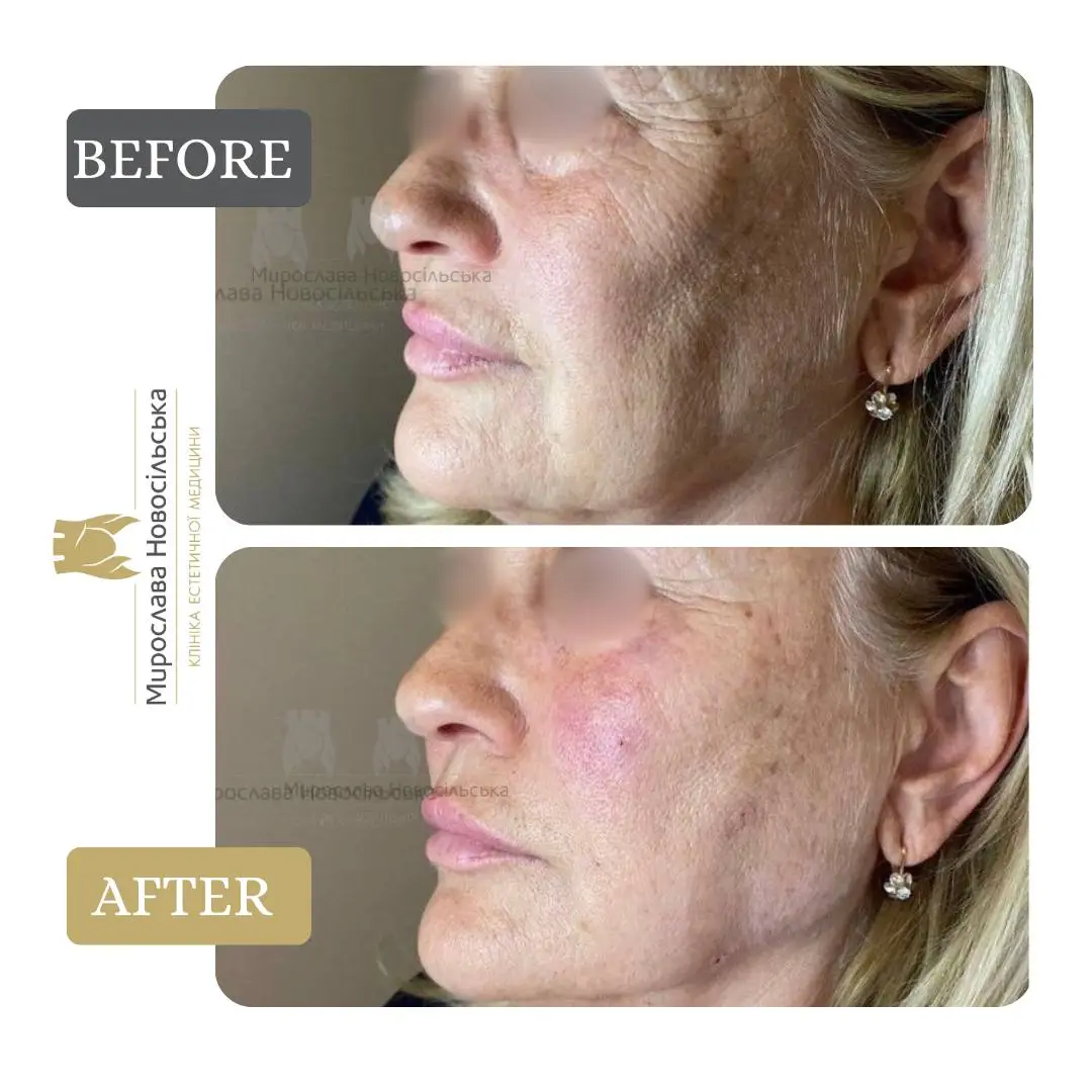 Radiesse injections, photo 5