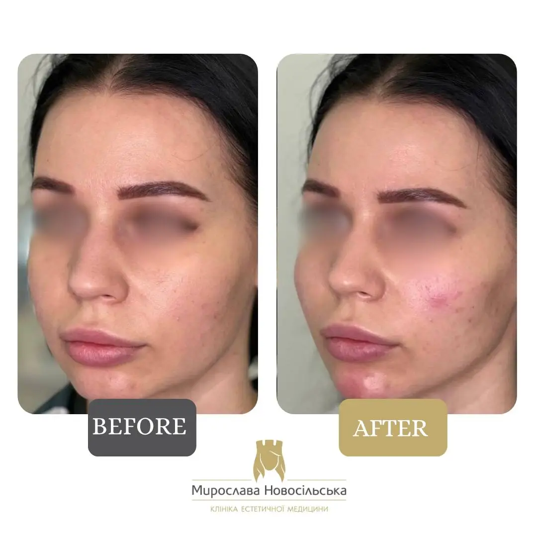 Radiesse injections, photo 6