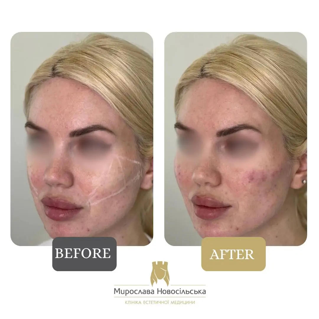 Radiesse injections, photo 7