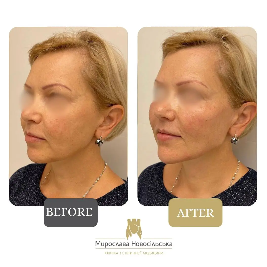 Radiesse injections, photo 8