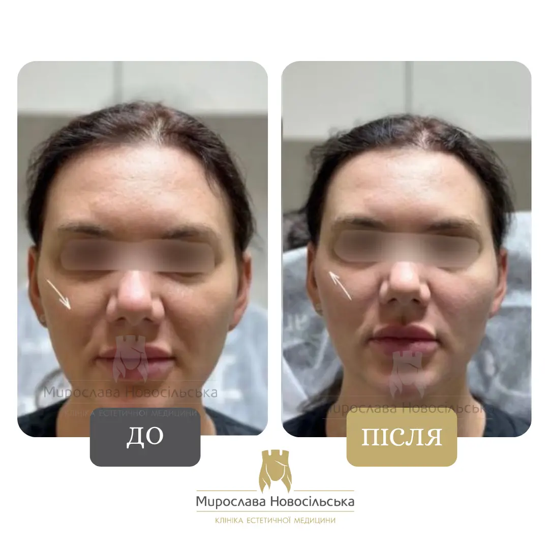 Ін’єкції Радієс (Radiesse), фото 3