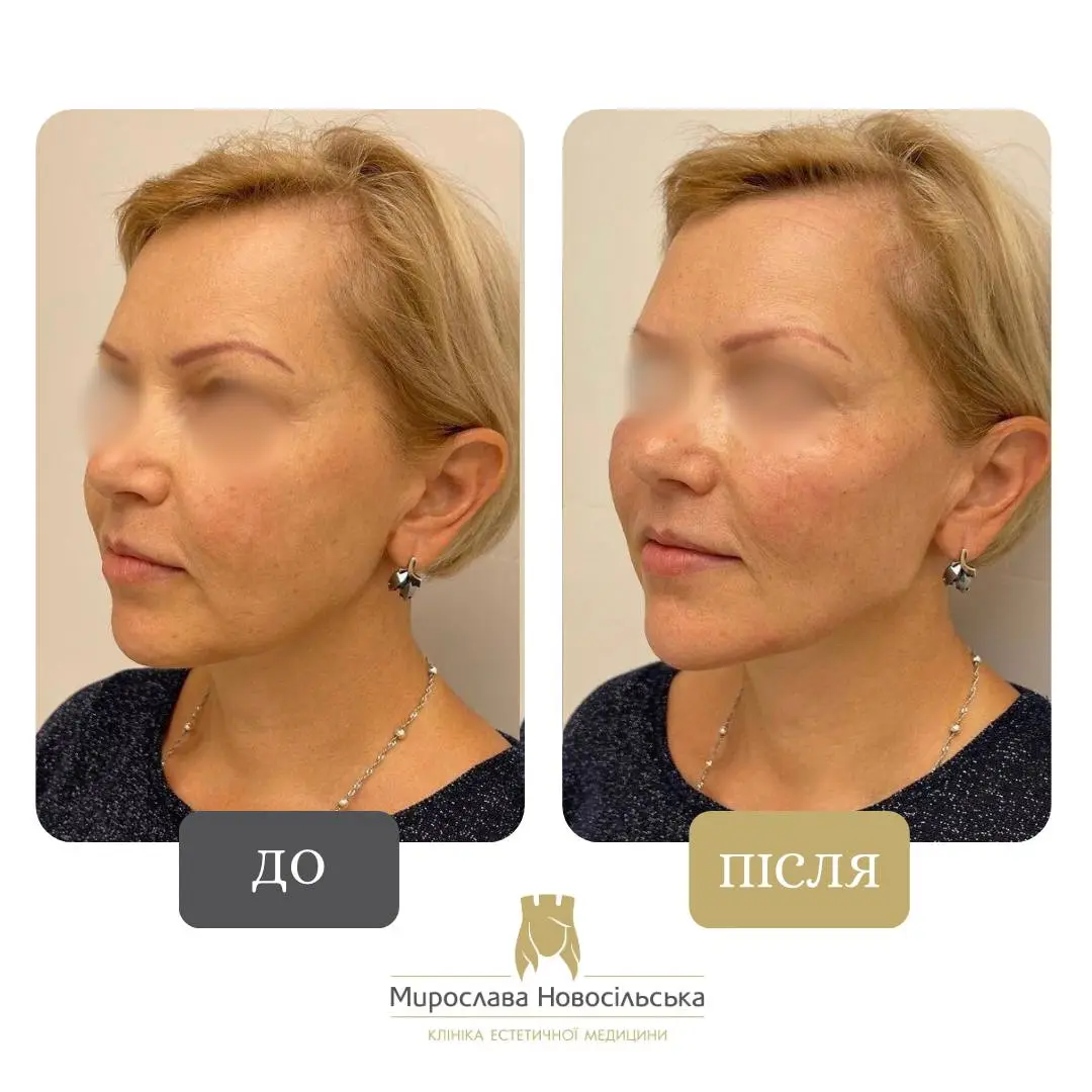 Ін’єкції Радієс (Radiesse), фото 8