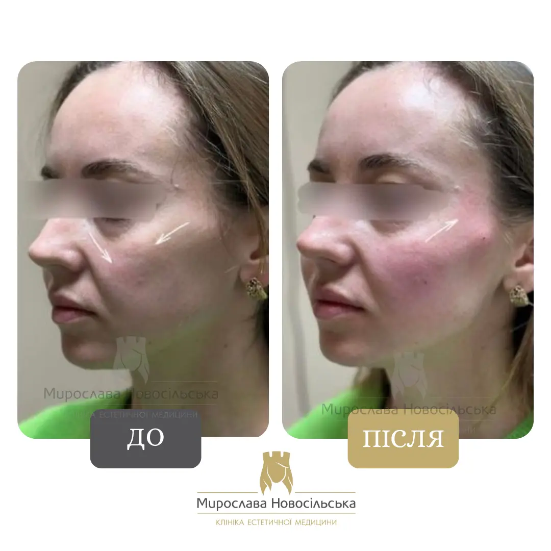 Ін’єкції Радієс (Radiesse), фото 2