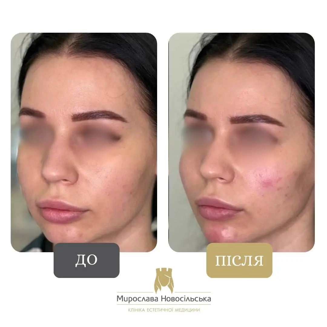 Ін’єкції Радієс (Radiesse), фото 6