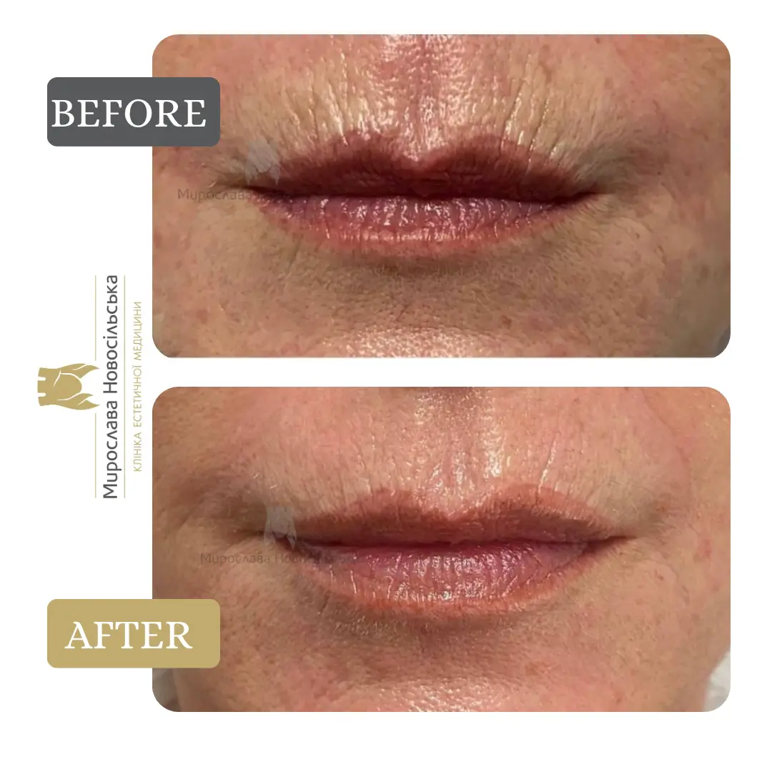 Face and body laser 4D rejuvenation, photo 6