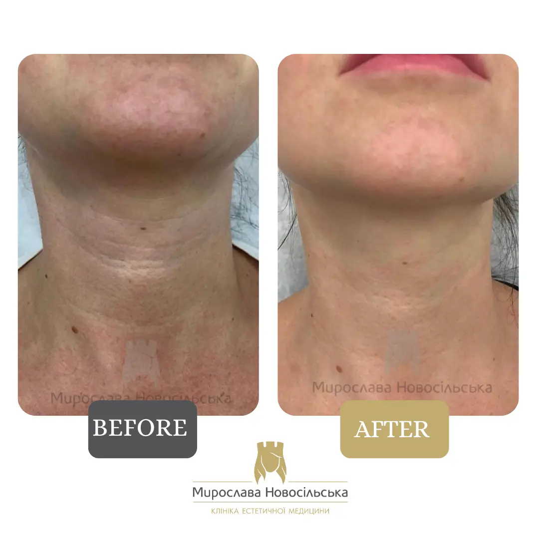 Face and body laser 4D rejuvenation