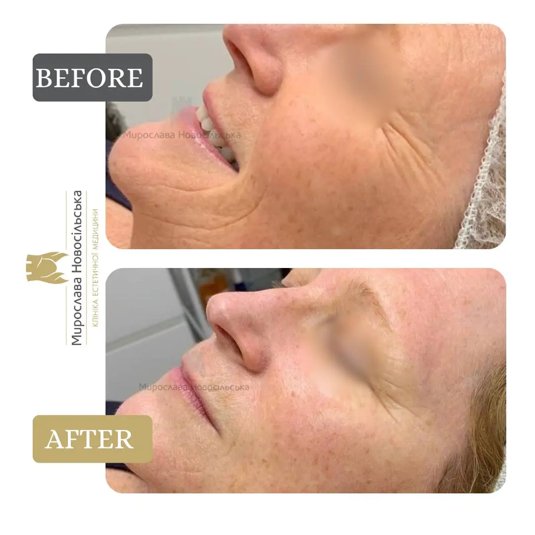 Face and body laser 4D rejuvenation, photo 2