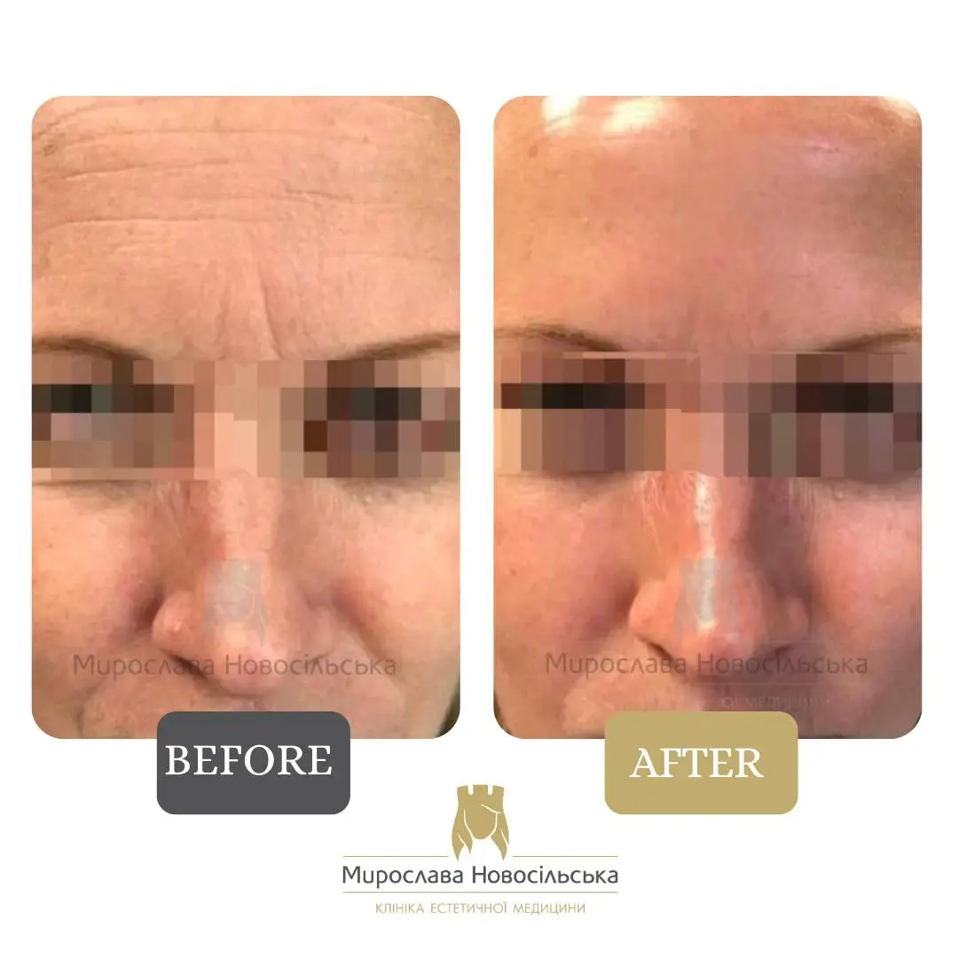 Face and body laser 4D rejuvenation, photo 3