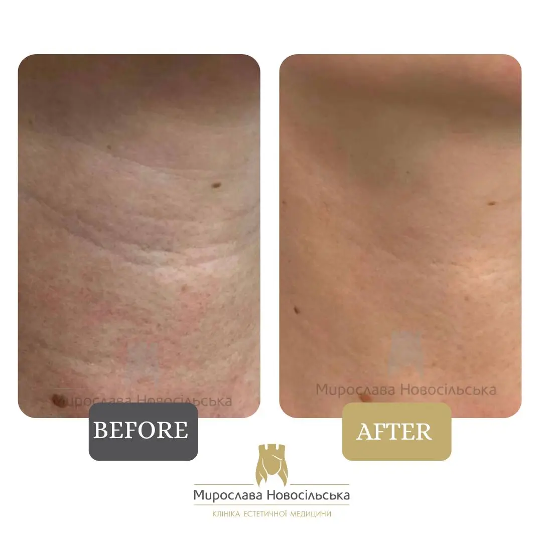 Face and body laser 4D rejuvenation, photo 5