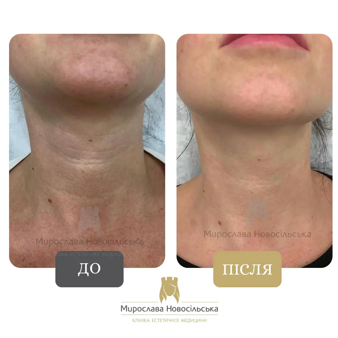 Лазерне 4Д омолодження обличчя і тіла, фото 4