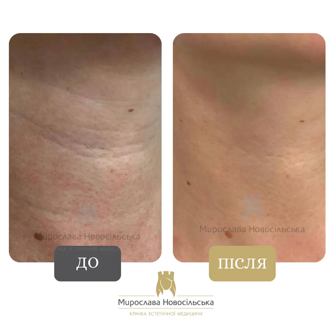 Лазерне 4Д омолодження обличчя і тіла, фото 5