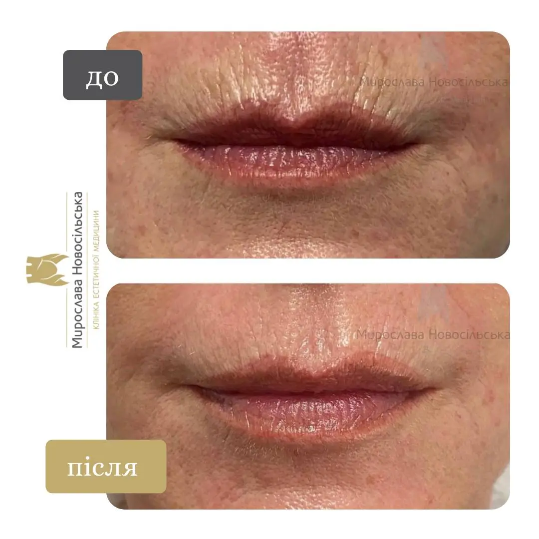 Лазерне 4Д омолодження обличчя і тіла, фото 6