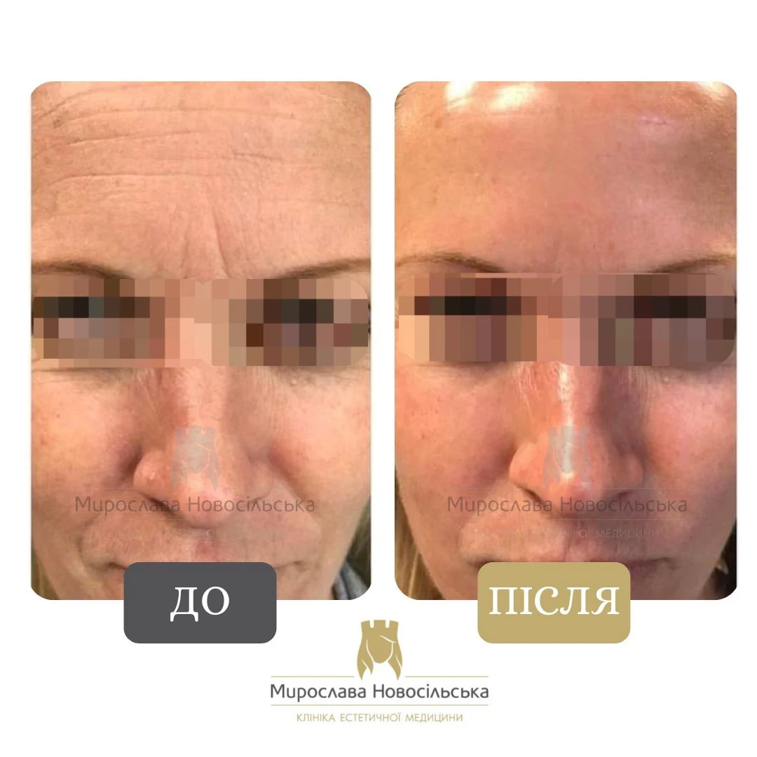 Лазерне 4Д омолодження обличчя і тіла, фото 3