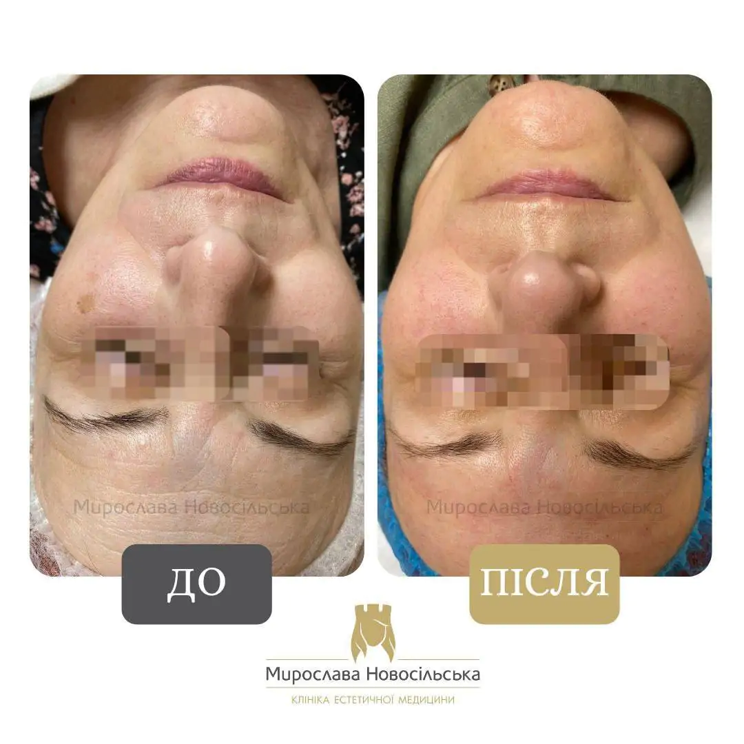 Лазерне 4Д омолодження обличчя і тіла, фото 7