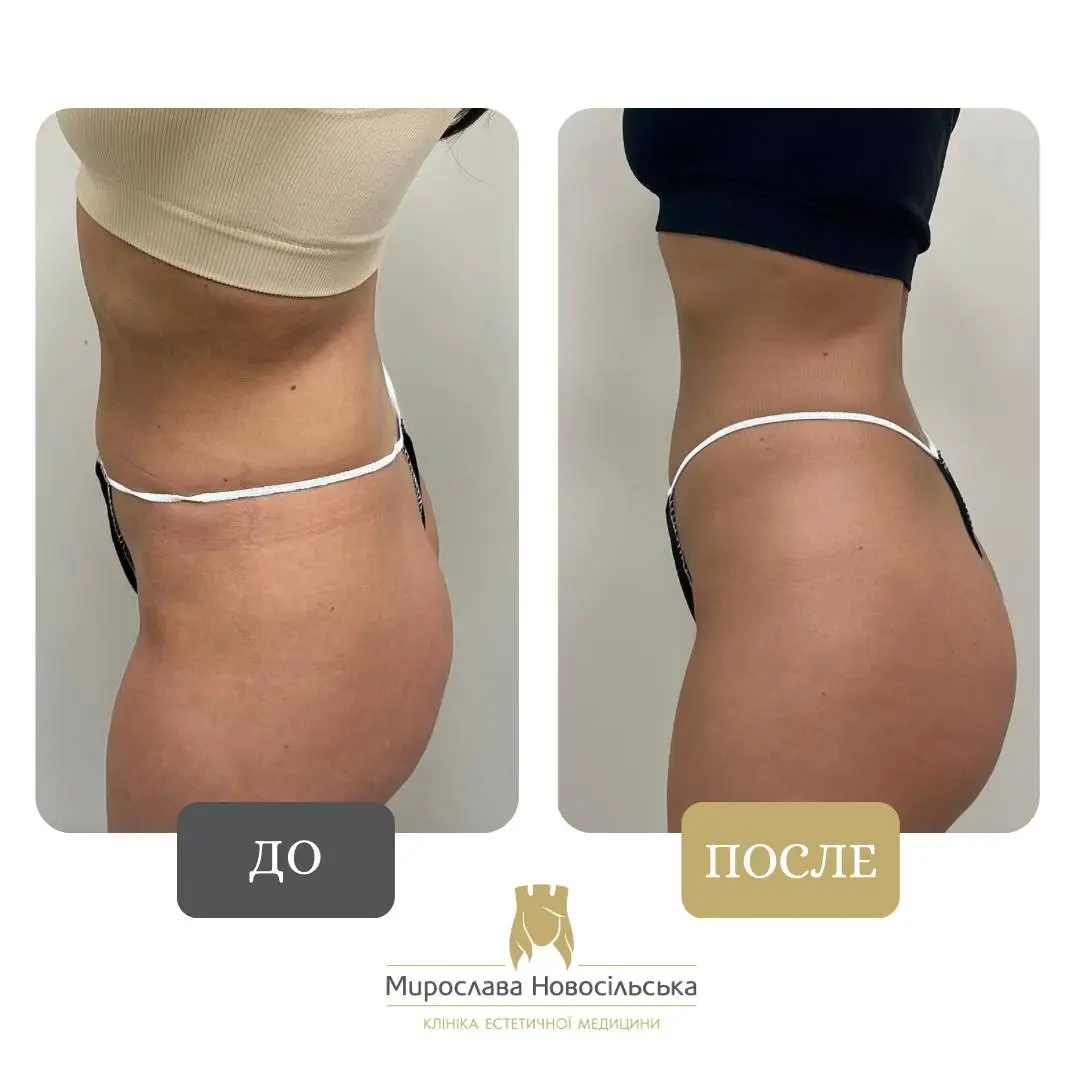 EMS – стимуляция мышц, фото 2