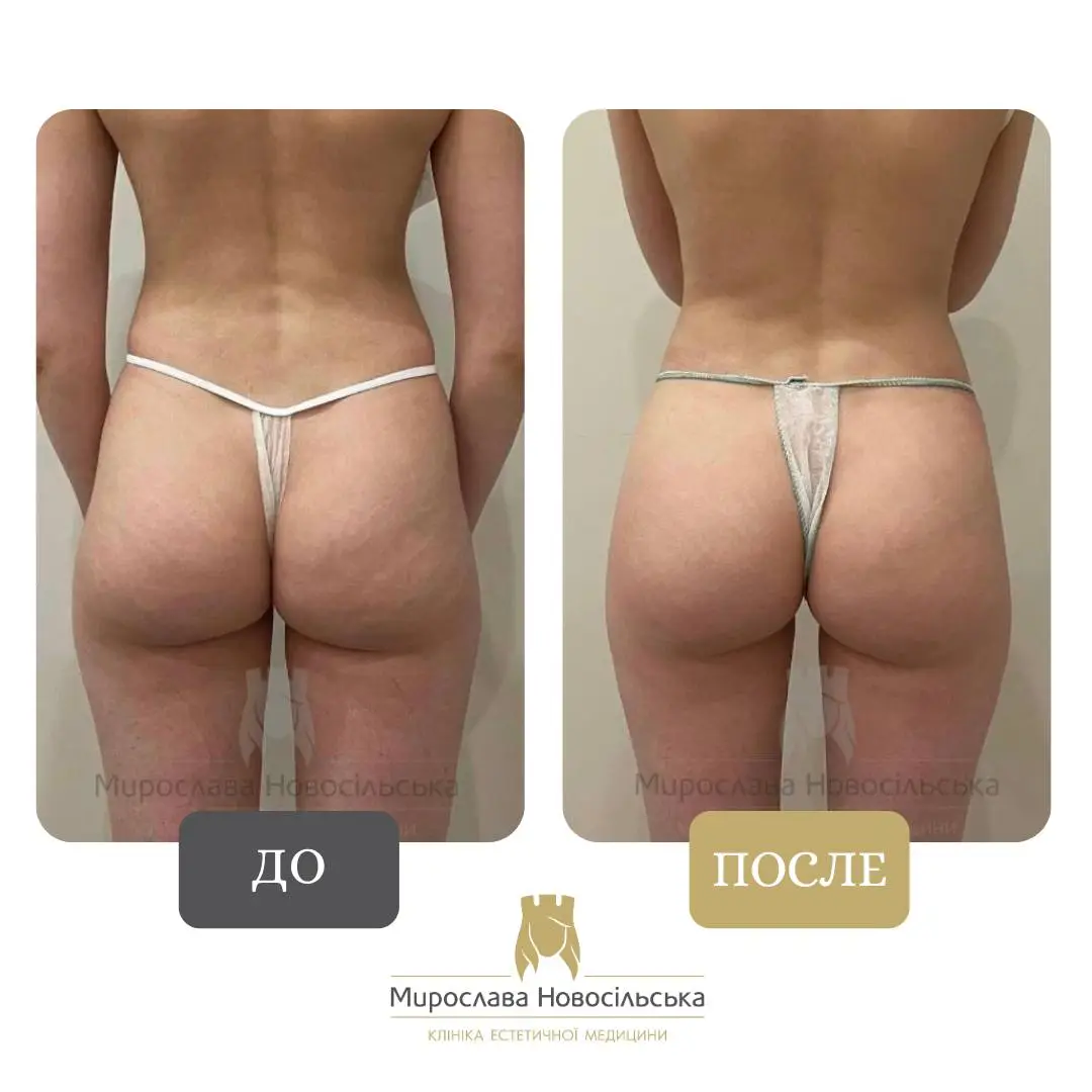 EMS – стимуляция мышц, фото 3