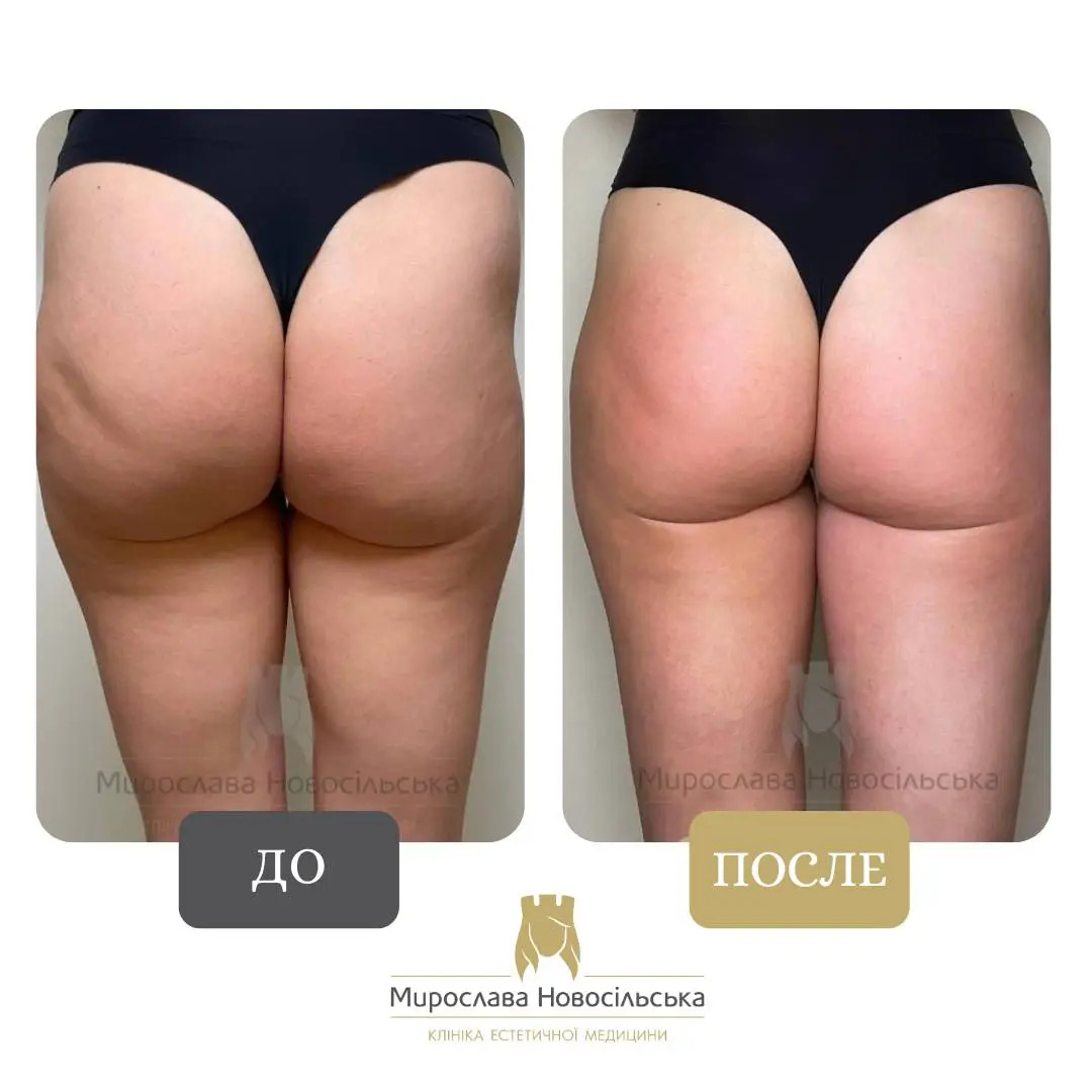 EMS – стимуляция мышц, фото 4