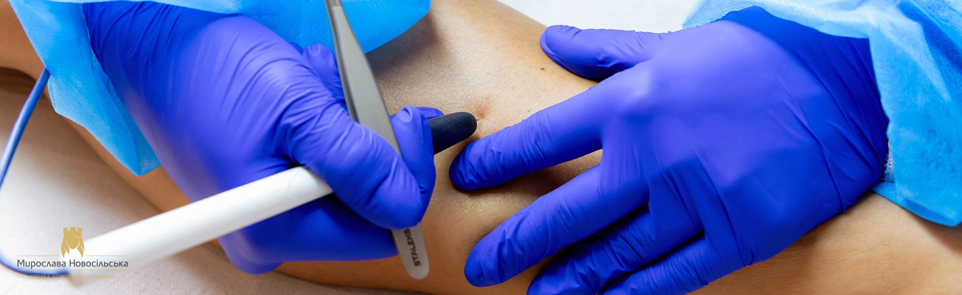 Electroepilation, photo 1