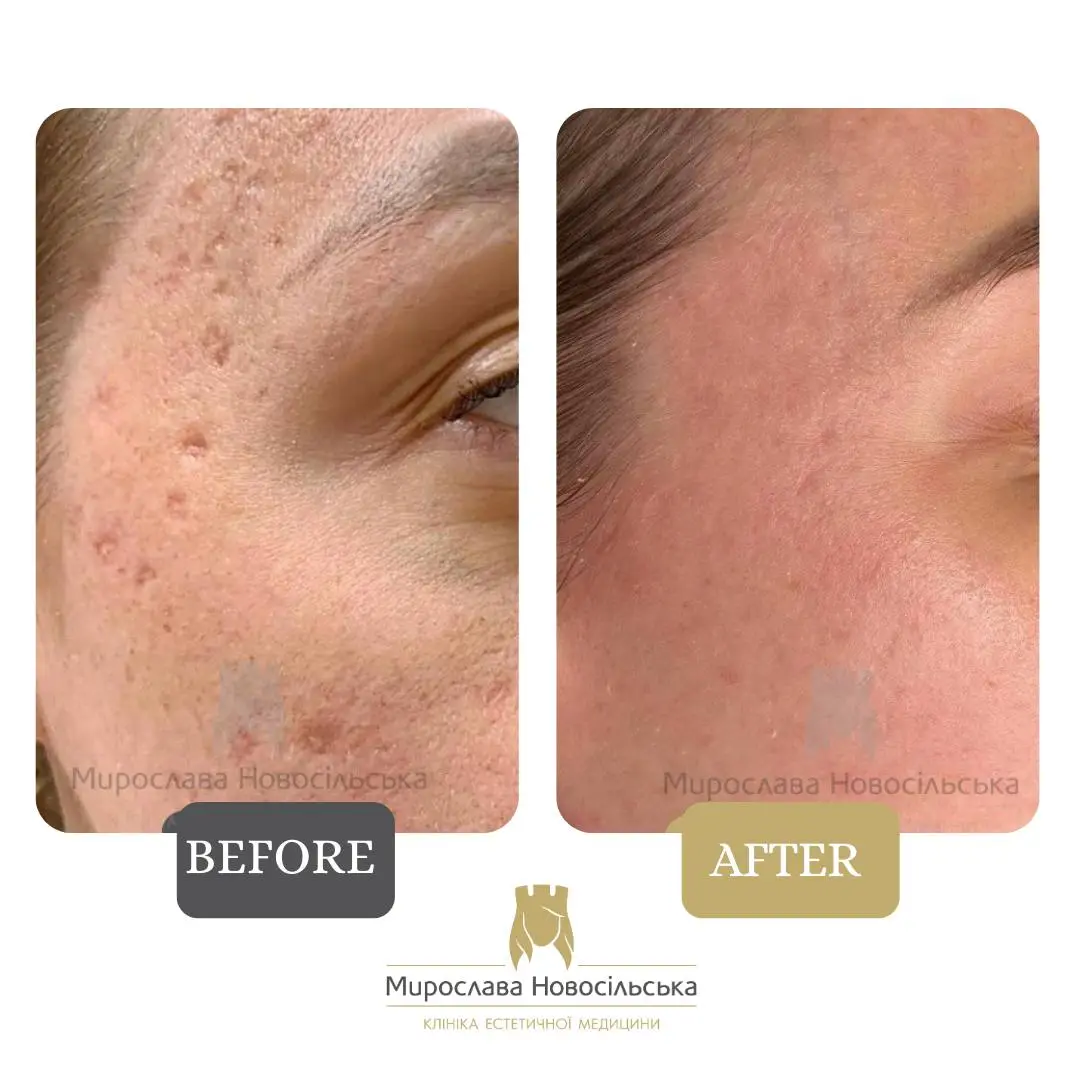 Laser resurfacing of scars and post acne