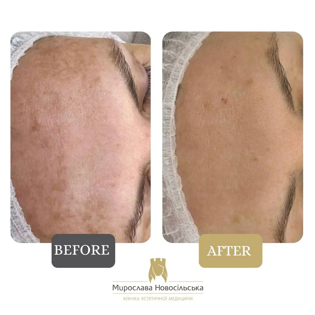 Laser resurfacing of scars and post acne, photo 13