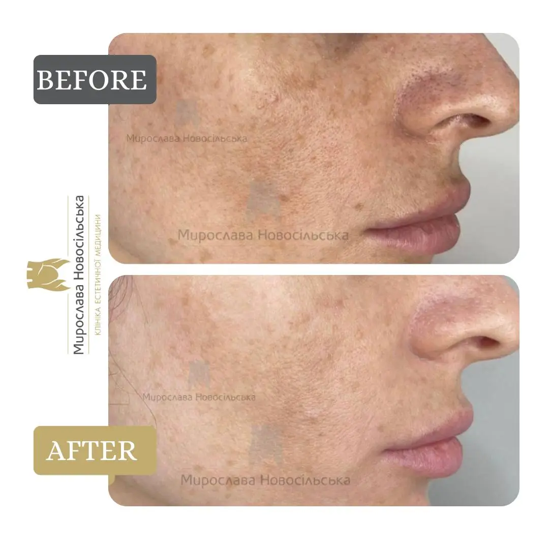 Laser resurfacing of scars and post acne, photo 15