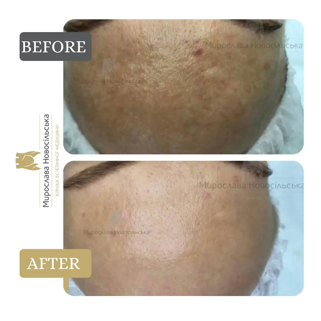 Laser resurfacing of scars and post acne, photo 16