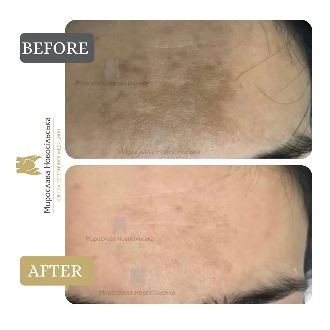 Laser resurfacing of scars and post acne, photo 17